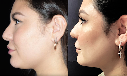 Double Chin Reduction Before After Mississauga Oakville
